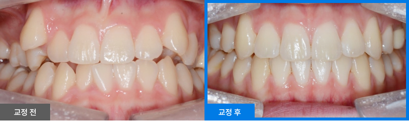 스케일링