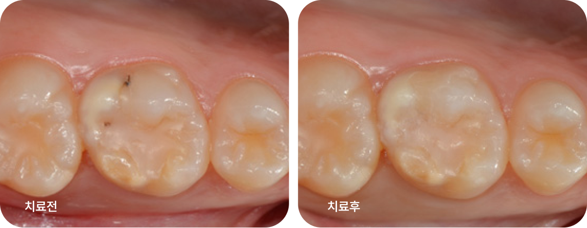 레진 치료 전 후 이미지