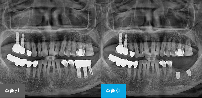 스케일링