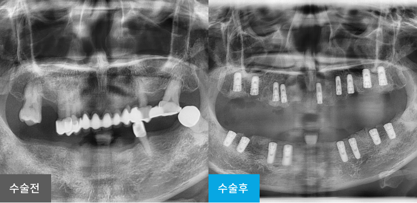 스케일링